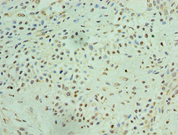 Immunohistochemistry of paraffin-embedded human breast cancer using THOC1 Polyclonal Antibody at dilution 1:100