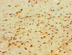 Immunohistochemistry of paraffin-embedded human breast cancer at dilution 1:100