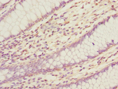 Immunohistochemistry of paraffin-embedded human colon cancer at dilution 1:100