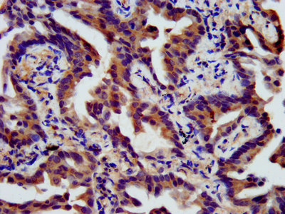 IHC image of SSH3 Polyclonal Antibody diluted at 1:400 and staining in paraffin-embedded human lung cancer performed on a Leica Bond&trade; system.